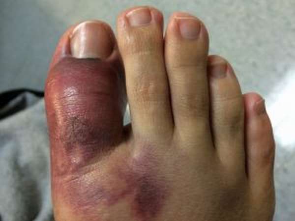 Пальцы ноги синеют и отекают при травме